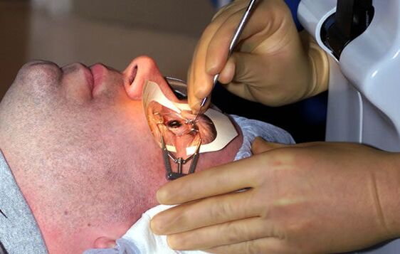 Miopiarako eskleroplastia ikusmena egonkortzeko