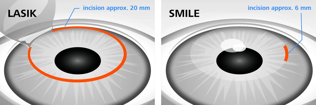 Laser ikusmena zuzentzeko LASIK eta SMILE metodoen alderaketa